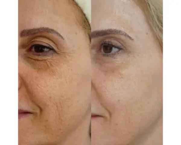 Vorher-nachher-Vergleich der Haut einer Frau: Deutliche Reduzierung von Falten und Pigmentflecken nach Anwendung von Retinol.