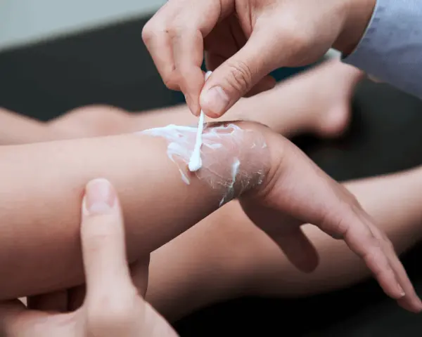 Delikatne smarowanie oparzonej skóry kremem na oparzenia za pomocą patyczka kosmetycznego.