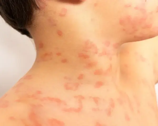 Primer plano de sarpullidos en la piel de un niño, con manchas rojas y elevadas en el cuello y el hombro.