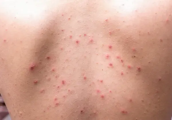 Skuteczne sposoby na pryszcze na plecach – jak się pozbyć problemu