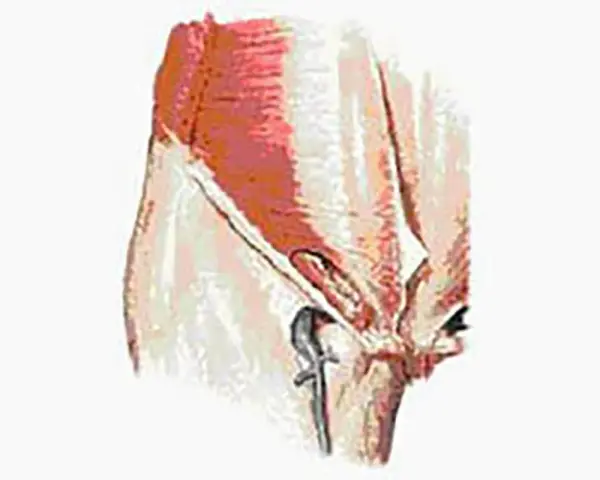 Illustration anatomique montrant la région pubienne, pertinente pour la pubalgie chez la femme.