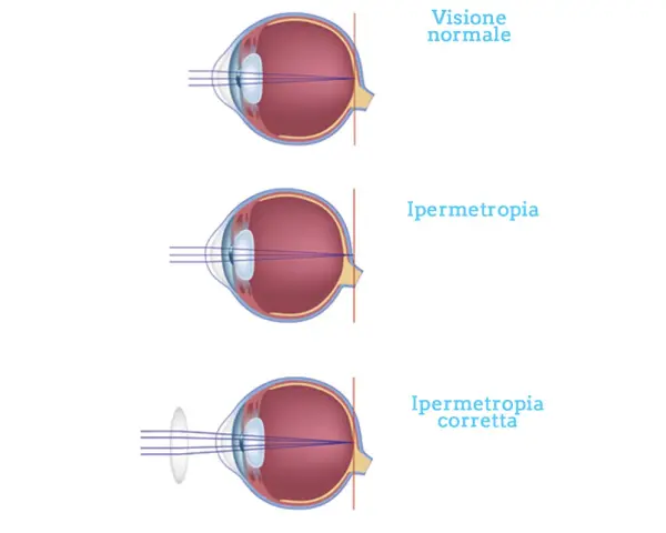 Illustrazione dell'ipermetropia oculare: visione normale, ipermetropia e correzione con lente.