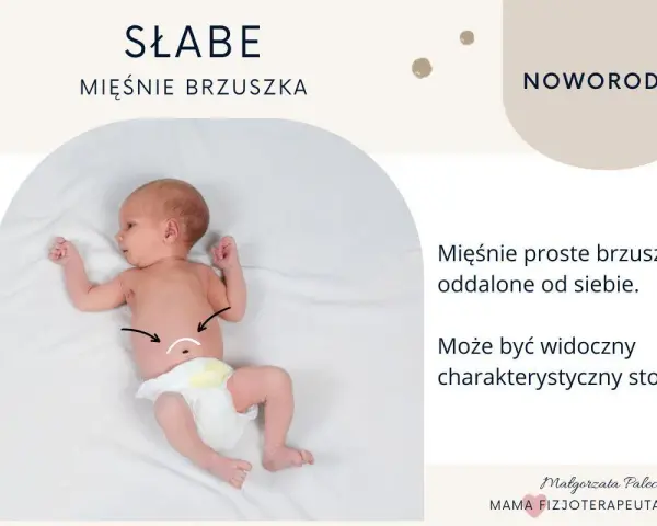 Noworodek z widocznym, wzdętym brzuchem. Mięśnie proste brzuszka są oddalone, tworząc charakterystyczny stożek.