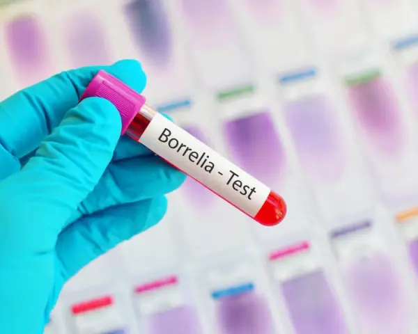 Ręka w niebieskiej rękawiczce trzyma probówkę z napisem "Borrelia - Test". To klucz do odpowiedzi, gdzie zrobić badania na boreliozę.