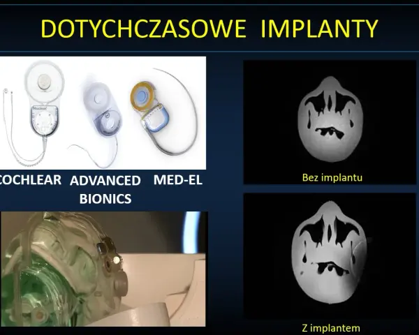 Nowoczesne implanty ślimakowe, w tym niewidoczny implant, poprawiają słuch.