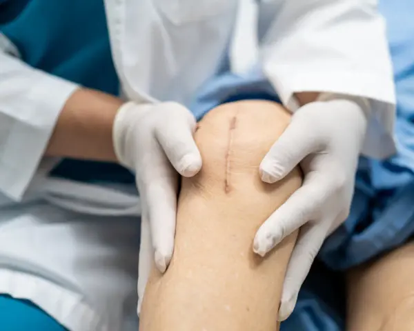 Lekarz w białej rękawiczce bada bliznę po operacji, która jest widoczna na kolanie pacjenta po zabiegu wszczepienia endoprotezy kolana.