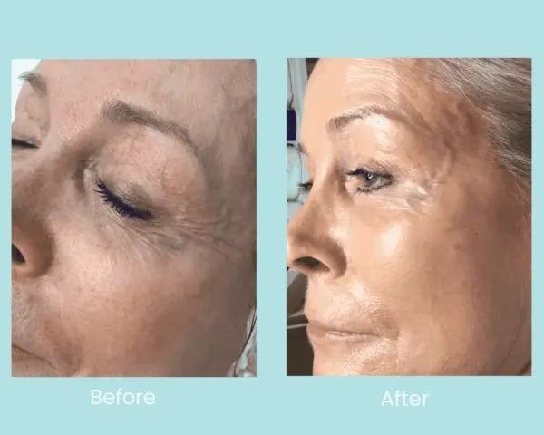 Before and after images show a woman's face. The "before" side displays dehydrated, dull skin with visible wrinkles. The "after" side reveals plump, hydrated, and radiant skin.