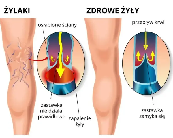 Ilustracja pokazuje nogę z żylakami i zdrową nogę. Flebolog wyjaśnia, że przy żylakach zastawki nie działają, powodując zapalenie.