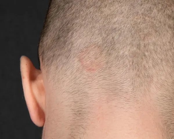 Rötlicher, ringförmiger Hautausschlag am Kopf, möglicherweise tinea corporis.