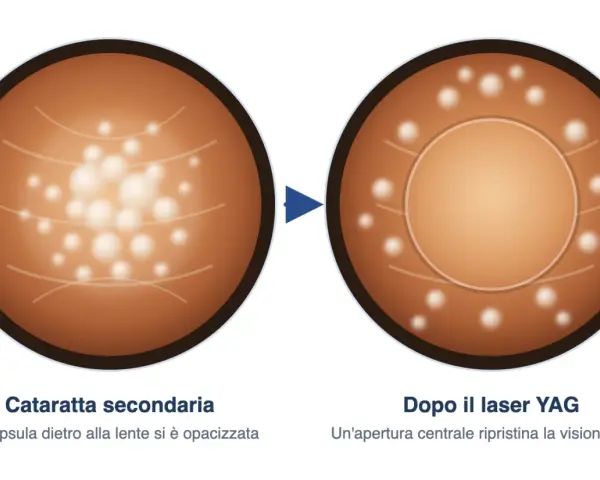 Prima e dopo il laser YAG: la capsula opacizzata della cataratta secondaria viene trattata con un barrage laser retina per ripristinare la visione nitida.