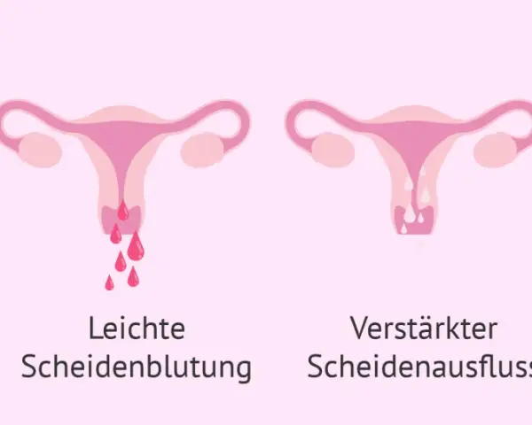 Brustveränderungen, leichte Blutungen, verstärkter Ausfluss und Müdigkeit können Anzeichen sein, dass die periode bleibt aus.