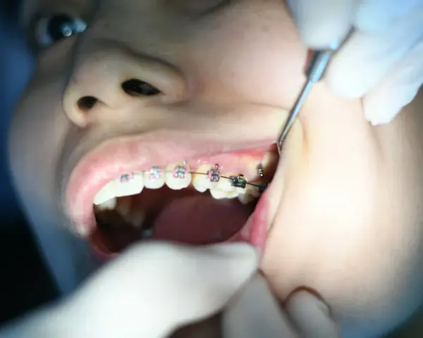 Aparat samoligaturujący wady zgryzu. Dentyści korygują zęby.