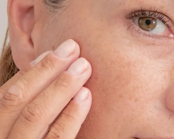 Dita sfiorano il viso, mostrando la texture della pelle e le lentiggini. Forse è il momento di applicare la pomata retinoica per un trattamento mirato.