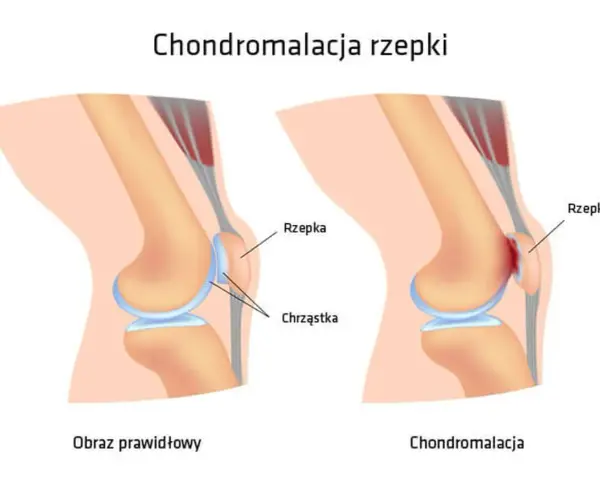 Porównanie zdrowego kolana z zaawansowaną chondromalacją 4 stopnia, gdzie chrząstka rzepki jest mocno uszkodzona.