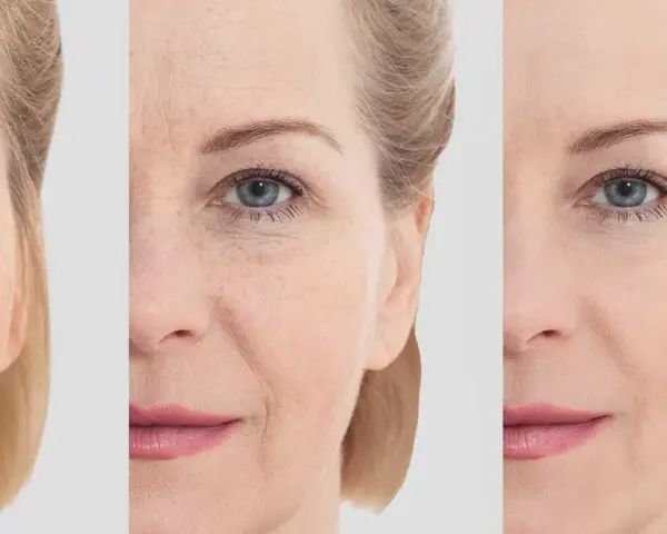 Comparaison avant/après : peau marquée par le temps, puis lissée grâce à l'acide hyaluronique sur le front et le visage.