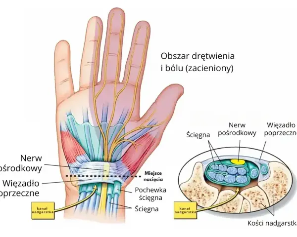 Anatomia dłoni ilustrująca ucisk na nerw pośrodkowy w kanale nadgarstka, powodujący drętwienie palców.