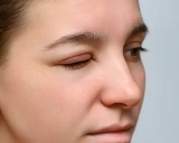 Occhi rossi e gonfi, forse per una reazione allergica. La palpebra è visibilmente gonfia e irritata.