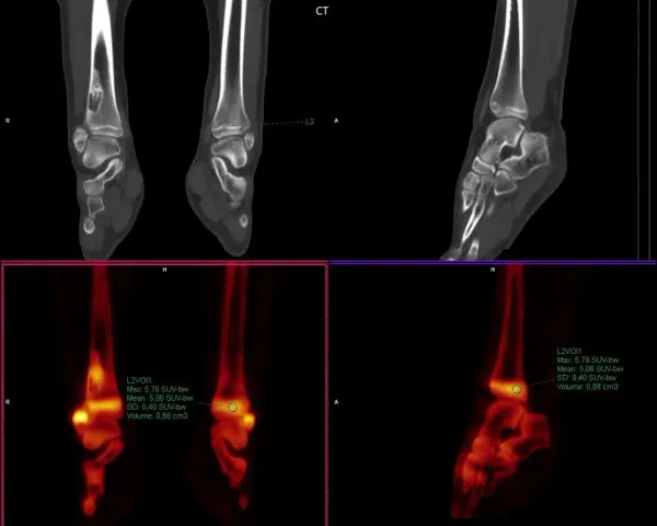Co to jest SUV max i dlaczego jest kluczowy w diagnostyce medycznej