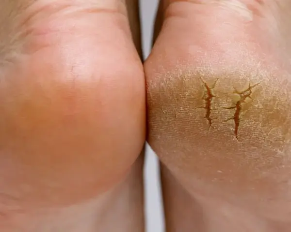 Gros plan sur deux talons, l'un sain et l'autre très sec, craquelé, montrant la différence de texture.