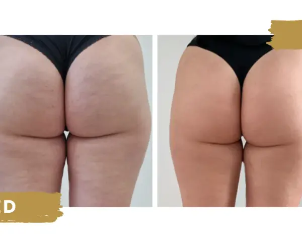 Endermologia: Jak działa, efekty, cena i wskazania poznaj wszystko