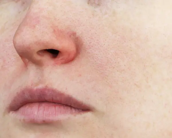 Gros plan sur un visage, avec un nez rouge froid, des lèvres fines et une peau marquée par les pores.