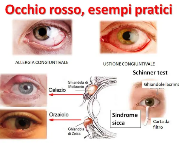 Occhio rosso che lacrima per allergia, ustione, calazio, orzaiolo e sindrome sicca. Test di Schirmer con carta da filtro.