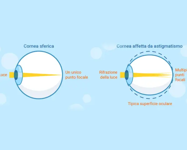Diagramma mostra come vede un astigmatico: la luce si focalizza in più punti invece che in uno solo, creando una visione sfocata.