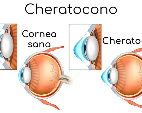 Confronto tra cornea sana e cheratocono: la vista di un occhio sano e uno affetto da cheratocono, che mostra la deformazione della cornea.