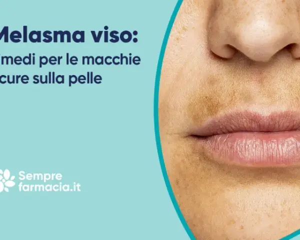 Primo piano del viso con macchie scure sopra il labbro, tipiche del melasma baffetti. Rimedi per le macchie scure sulla pelle.