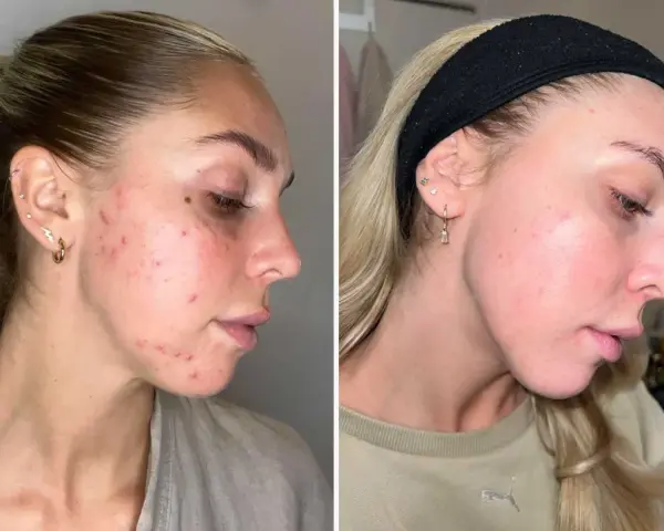 Före- och efterbilder visar en kvinnas hud med hormonspiral akne som förbättrats avsevärt.