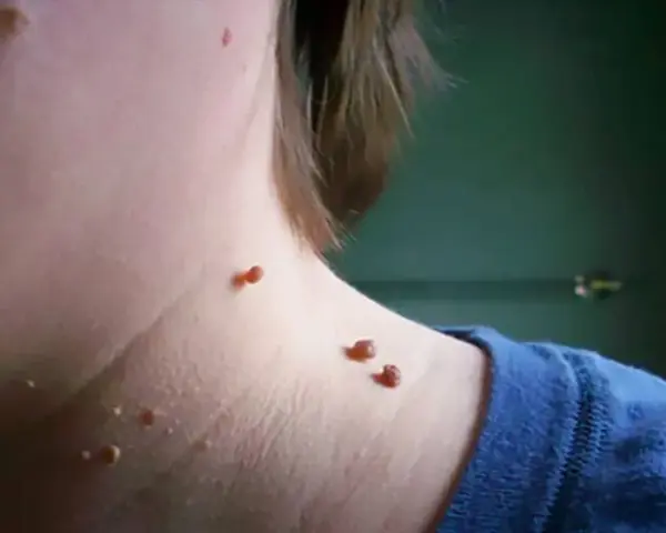 Piel con varias verrugas marrones y rojizas en el cuello, algunas agrupadas, sugiriendo la necesidad de quemar verrugas.