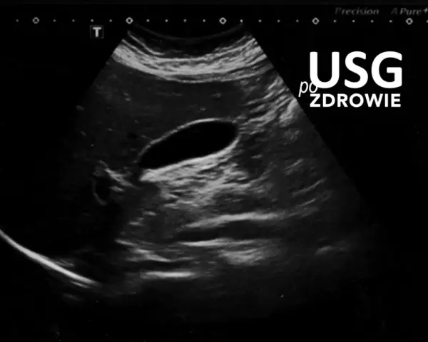Obraz USG przedstawia pęcherzyk żółtkowy, ważny element układu trawiennego.