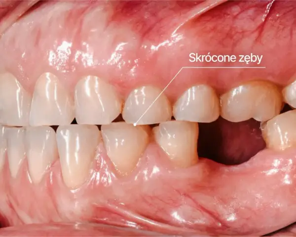 Widoczne skrócone zęby, jeden z objawów bruksizmu. Zęby są starte, co może prowadzić do bólu i dyskomfortu.