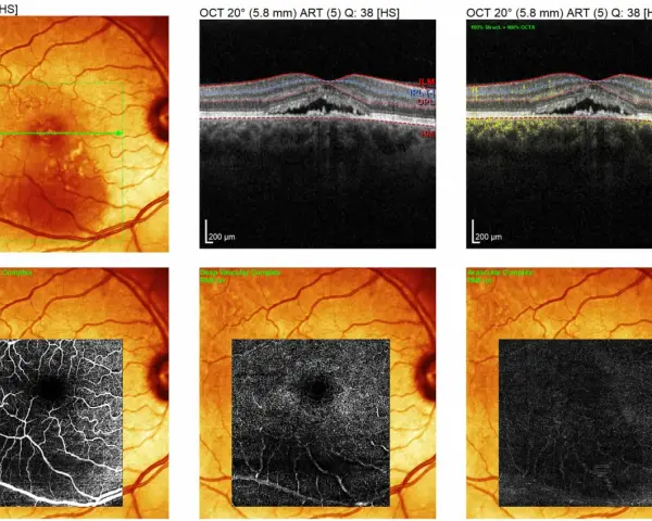 Immagini OCT e IR di un occhio con segni di retinopatia da stress, mostrando alterazioni vascolari e strutturali.