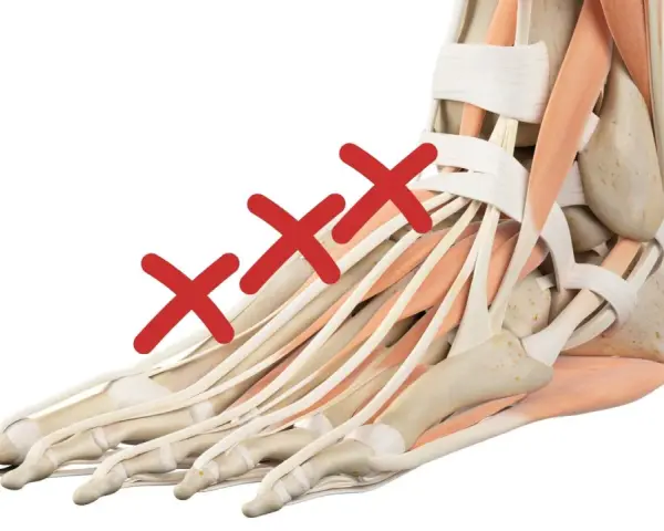 Anatomia del piede con tre croci rosse sui tendini, indicando un problema come il collo del piede gonfio.