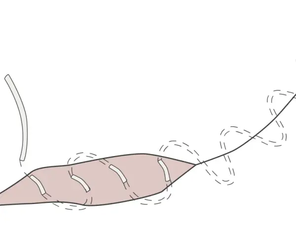 Ilustracja przedstawia szew śródskórny, gdzie nici chirurgiczne są ukryte pod skórą, zapewniając estetyczne gojenie rany.