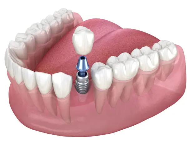 Brak piątki? Ile kosztuje implant, most, proteza? Porównanie cen