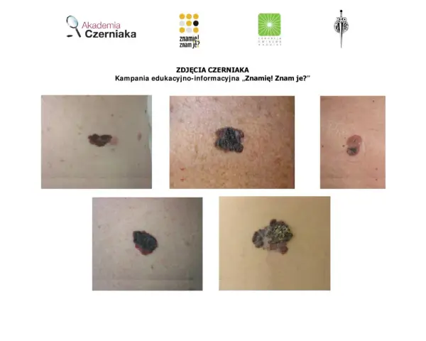 Zbliżenia różnych znamion i czerniaków na skórze.