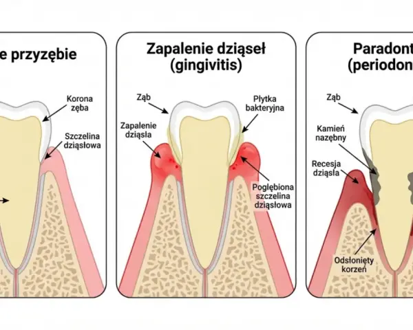 Ilustracja pokazuje postęp chorób przyzębia: zdrowe dziąsła, zapalenie dziąseł i paradontozę. Czy paradontoza jest zaraźliwa?
