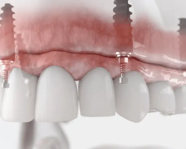 Model szczęki z implantami. Podniesienie dna zatoki szczękowej cena zabiegu jest kluczowa dla stabilności implantów.