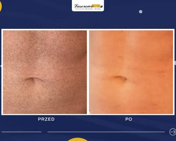 Przed i po depilacji laserowej brzucha. Widoczne spektakularne efekty redukcji owłosienia.