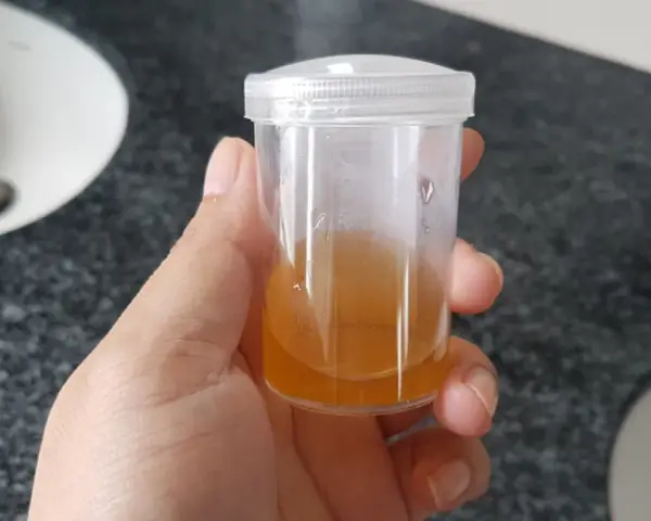 Próbka moczu z widocznymi fosforanami bezpostaciowymi, ważna w diagnostyce ciąży.