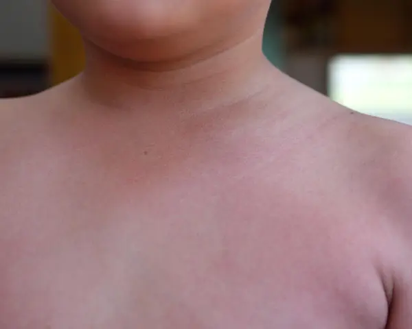 Pelle arrossata con piccoli puntini scarlattina inizio, forse un segno di febbre o un'eruzione cutanea.