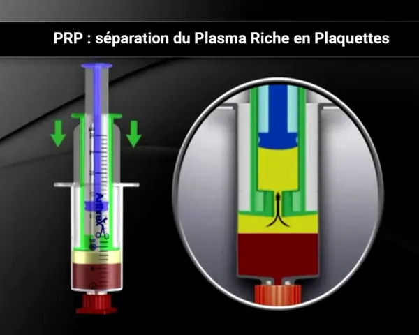 Illustration d'une seringue pour la séparation du plasma riche en plaquettes (PRP) pour un cheval.