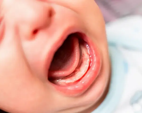 Usta niemowlaka z widocznym językiem i dziąsłami. Może to być związane z za krótkim wędzidełkiem u niemowlaka objawy.