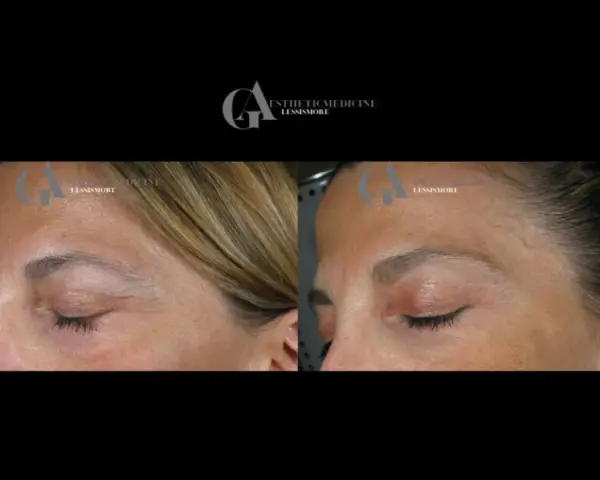 Confronto botox viso prima e dopo: rughe attenuate sulla fronte e contorno occhi più disteso.