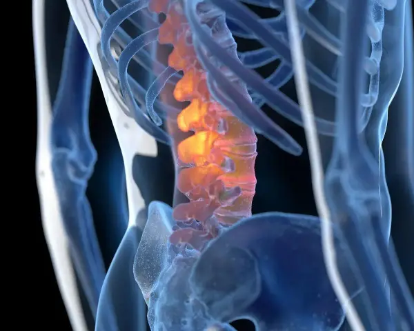 Anatomical rendering of a human spine with inflamed vertebrae, highlighted in orange and red.