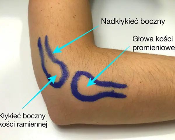 Zaznaczone na niebiesko struktury anatomiczne łokcia: nadkłykieć boczny kości ramiennej, głowa kości promieniowej i kłykieć boczny kości ramiennej.