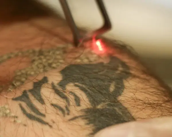 Laser usuwanie tatuażu. Czerwony promień lasera rozjaśnia ciemny wzór na skórze, rozpoczynając proces usuwania tatuażu.