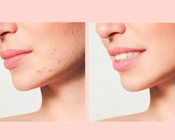 Prima e dopo: pelle con imperfezioni e poi pelle liscia e luminosa, mostrando la trasformazione dopo il processo di skin purging.